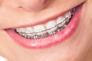clear-ceramic-dental-braces-300×200