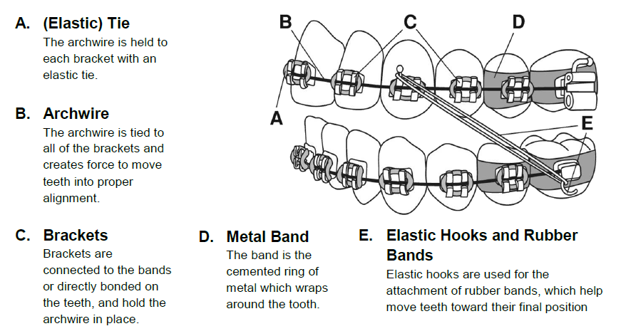 Ortho Emergency, Dulaney Orthodontics