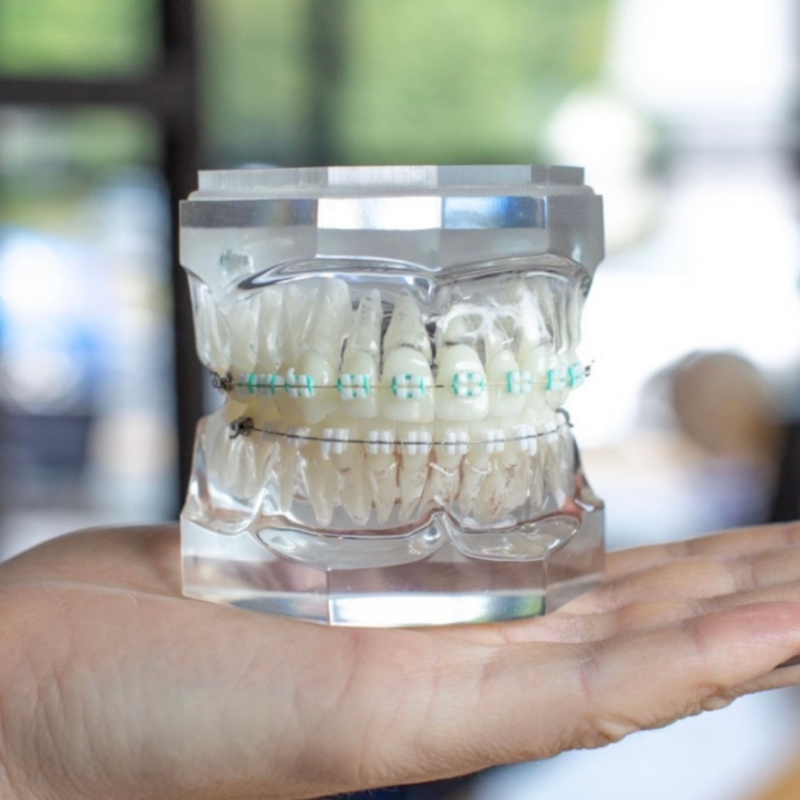LightForce™ Custom Braces Dupont Orthodontics Dr. Allison S